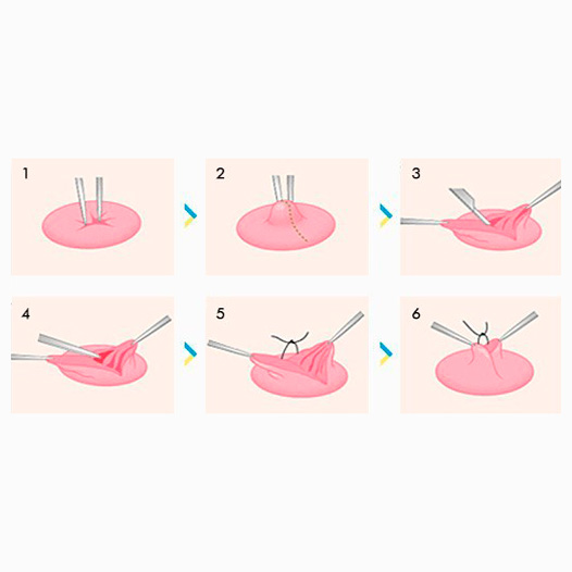 Pezón umbilicado o invertido