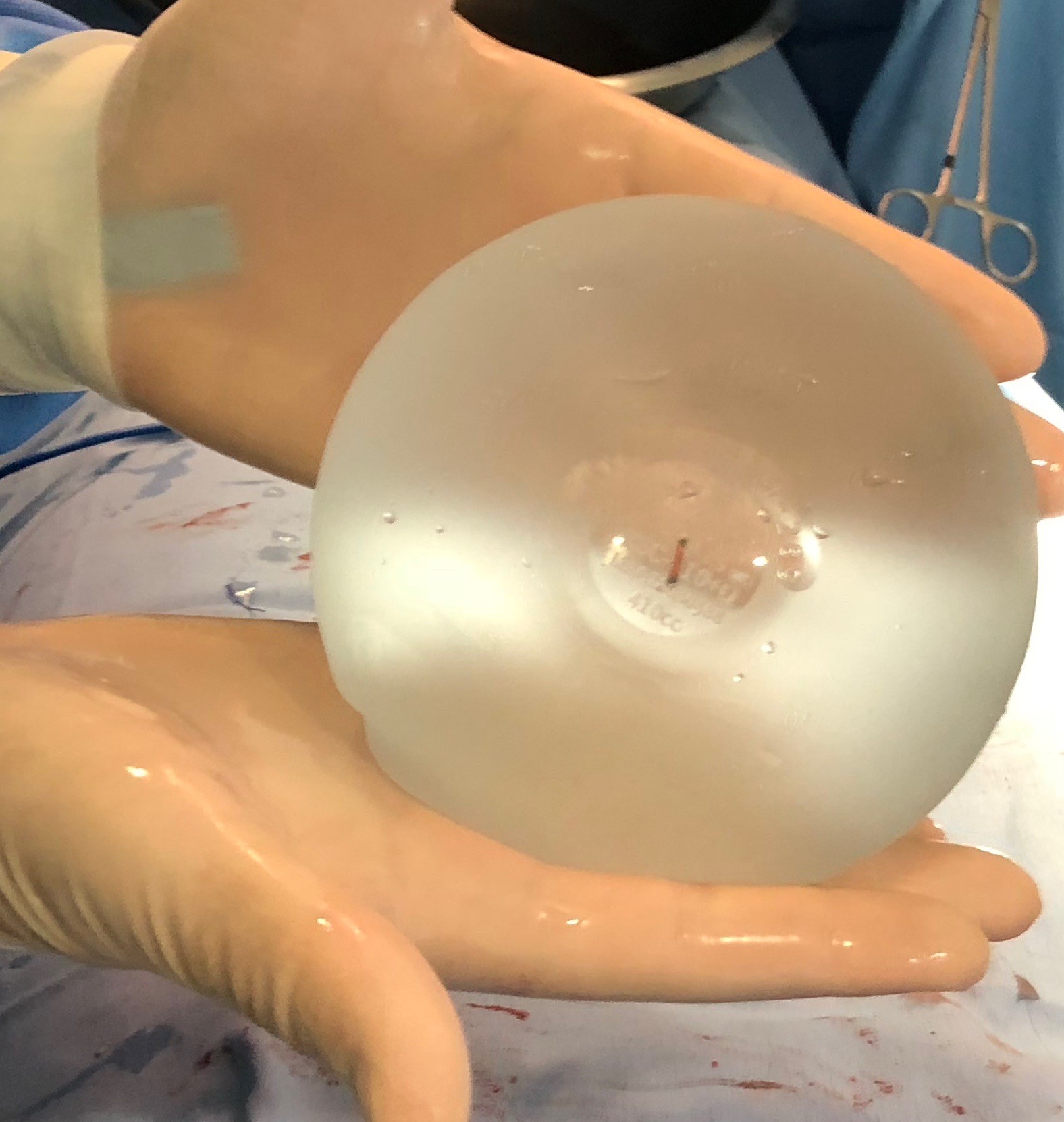 La innovación y seguridad en los implantes de mama