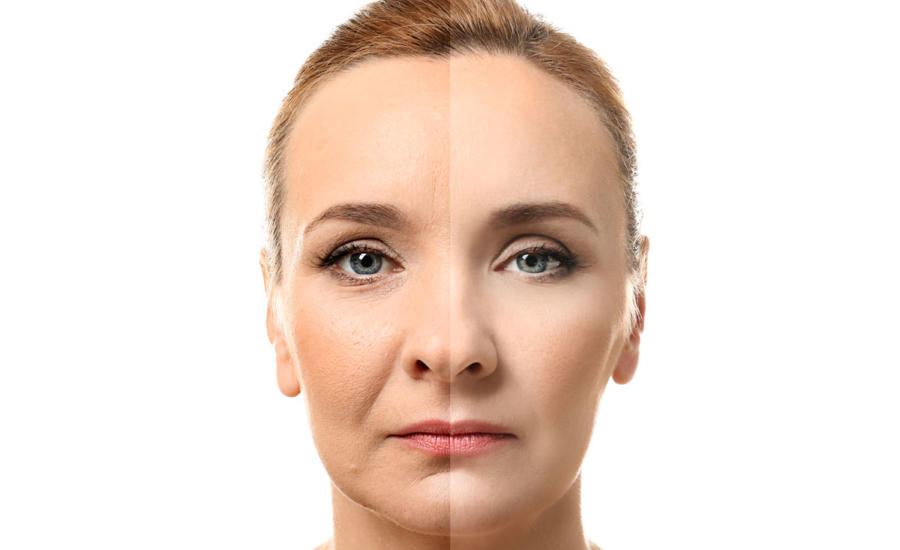 Lifting Endoscópico para frenar los signos de la edad