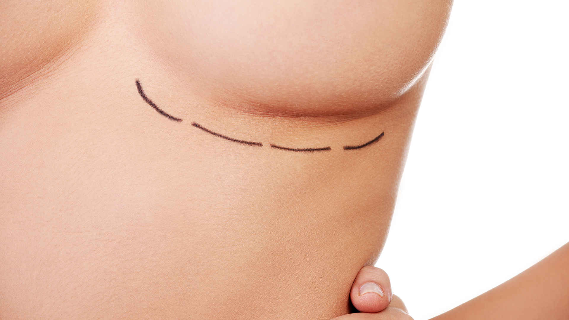 ¿Qué es la cirugía secundaria de mama?