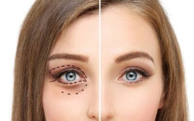 Blefaroplastia: un tratamiento para rejuvenecer la mirada