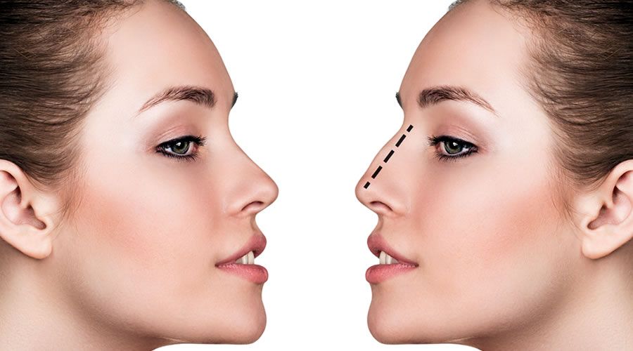 Rinoplastia: una decisión importante