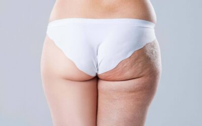 Celulitis vs. Sobrepeso: ¿Cuál es la diferencia y cómo combatirlas?