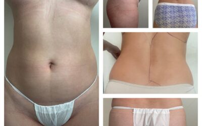 Liposucción y Abdominoplastía