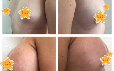 Mamoplastia de aumento