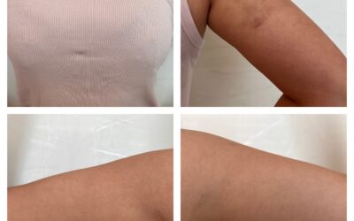 Braquioplastia o Lifting de Brazos