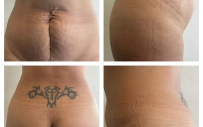 Abdominoplastia