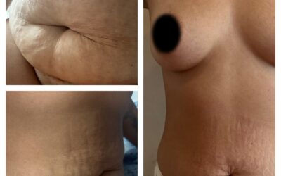 Abdominoplastia